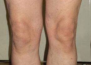 Osteflex erabili ondoren, artikulazioak normaltasunera itzuli dira